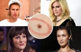 Cos'&egrave; la malattia di Lyme, la patologia trasmessa dalle zecche che tormenta le star