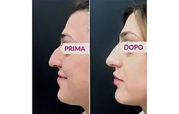 Si pu&ograve; rimodellare il naso senza bisturi? 
La parola all'esperta