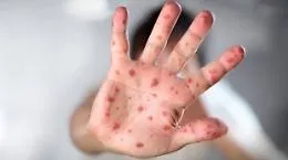 Focolai di morbillo nel mondo: &laquo;Sono 21 le tipologie dirompenti&raquo;