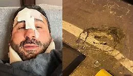 Lo chef Natale Giunta furioso dopo caduta dal monopattino: &laquo;Grazie a Palermo per le tante buche&raquo;