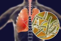 Cos'&egrave; la Legionella: le fonti d'infezione, i soggetti a rischio, i sintomi e la prevenzione
