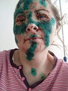 Farmacista di Kharkiv sfigurata dai bombardamenti: il Ministero mostra la foto