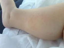 Dermatite atopica, in estate sotto controllo con gel facili da spalmare