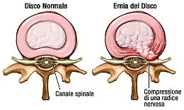 Ernia del disco, stili di vita corretti per prevenirla: validi aiuti da un manipolatore e dalle medicine