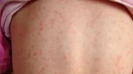 Boom di scarlattina ed &egrave; corsa a test e antibiotici