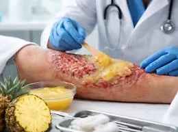 L'emergenza dopo il rogo in Svizzera: il farmaco per le ustioni &egrave; fra i medicinali carenti in Italia