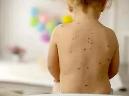 Morbillo, la Sicilia &egrave; la regione con meno vaccinati di tutt&rsquo;Italia: solo il 67,8% e l'immunit&agrave; di gregge diventa un'utopia