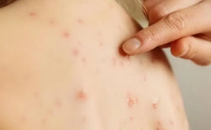 Coronavirus, quei segni sulla pelle che possono essere un campanello d'allarme