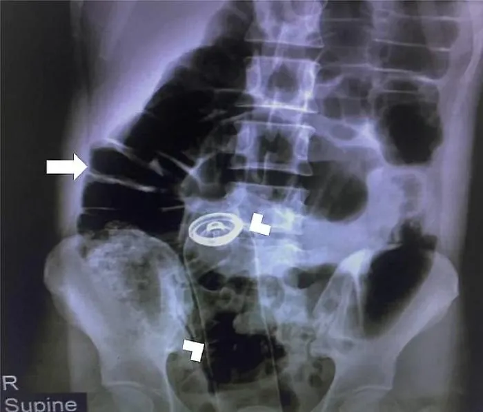 deodorant-rectum-x-ray
