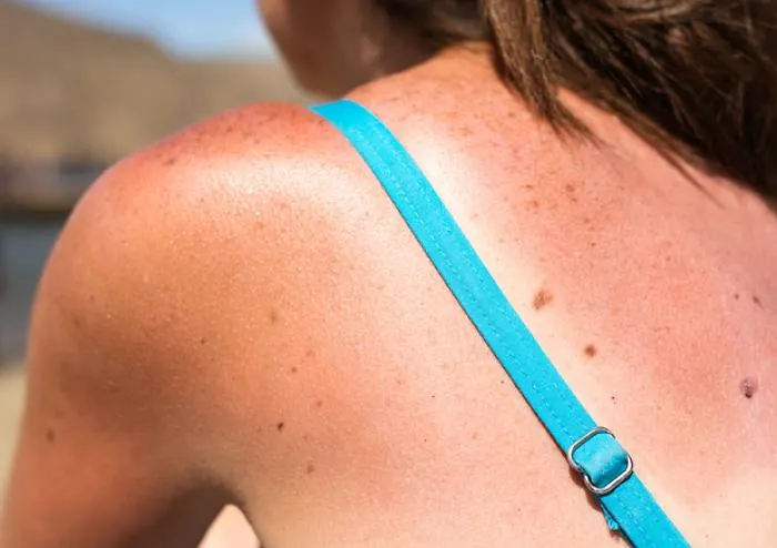 La nuova molecola che potrebbe cambiare la cura del melanoma prima dell&rsquo;intervento