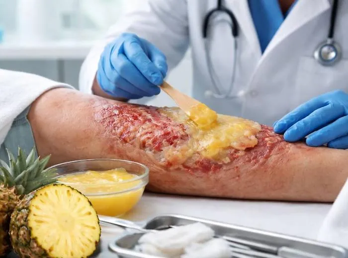 L'emergenza dopo il rogo in Svizzera: il farmaco per le ustioni &egrave; fra i medicinali carenti in Italia