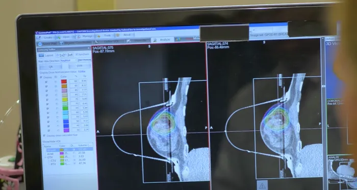 Tumore al seno, al Pascale di Napoli una radioterapia sub-millimetrica con meno sedute