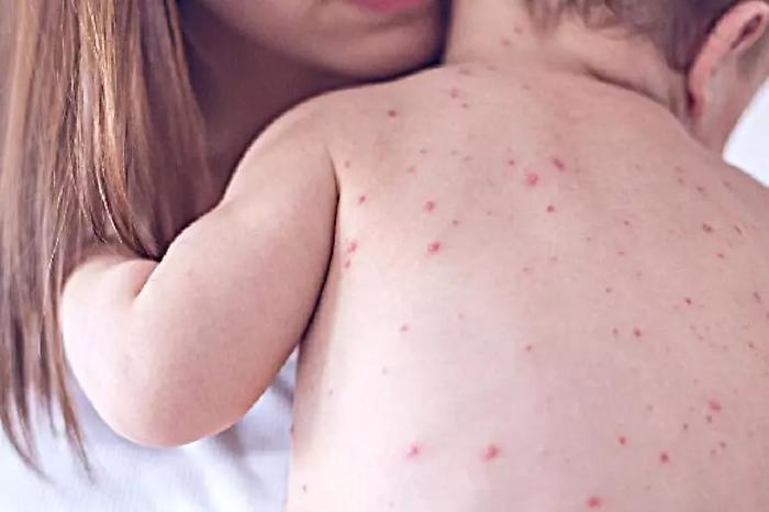 Morbillo in ripresa nel 2026: boom di casi anche tra adulti e allarme per le seconde dosi